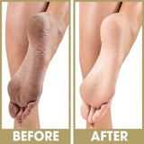 Prolinc Callus Eliminator 1oz
